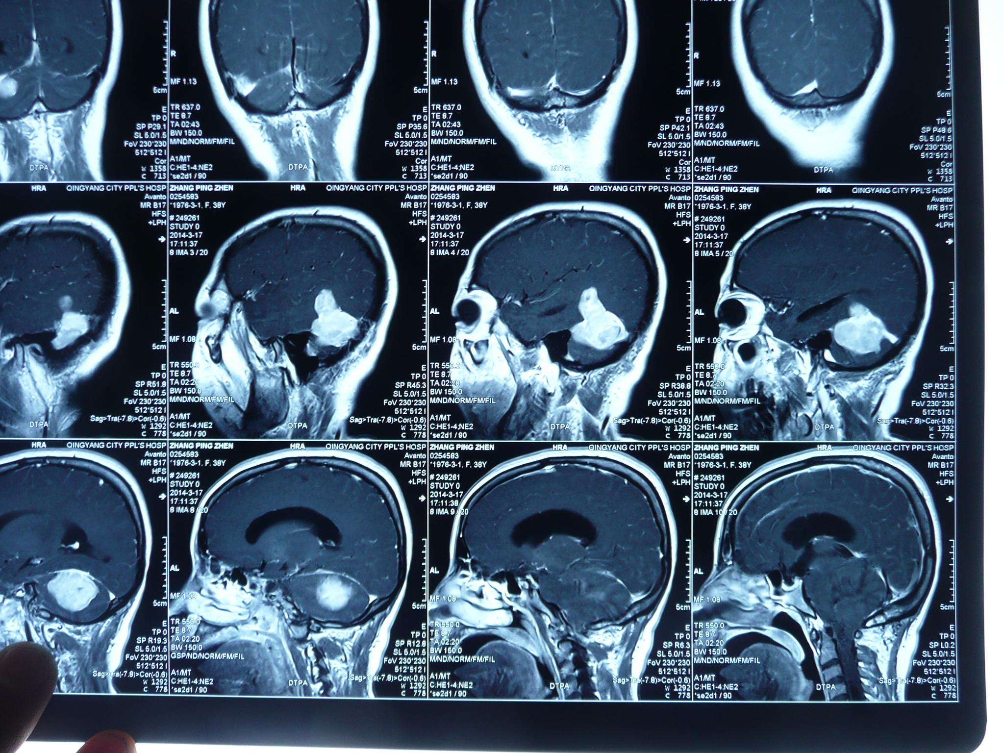 贺晓生教授小脑幕上下骑跨脑膜瘤的外科切除手术案例
