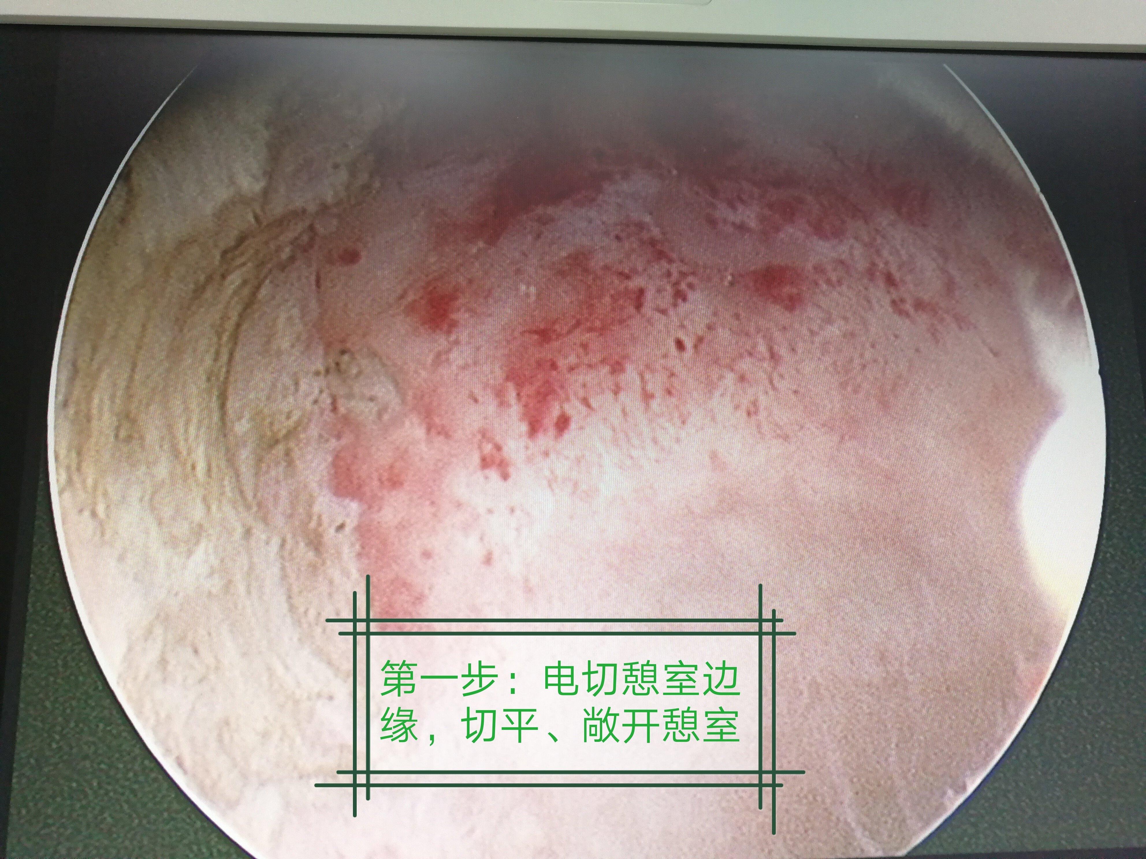 手术解析宫腔镜下切除剖宫产术后子宫切口憩室