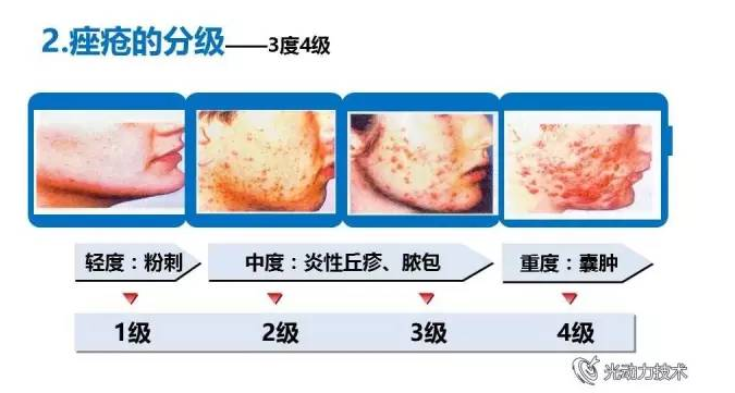 中国痤疮治疗指南2014版