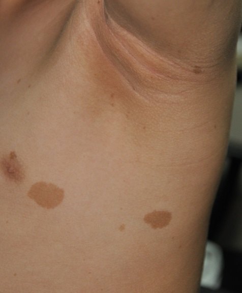 图示:经典牛奶咖啡斑及腋窝雀斑2.神经纤维瘤体或丛状神经纤维瘤.