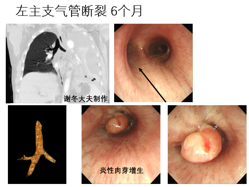 气管支气管破裂或穿孔原则上均应手术治疗,保守治疗仅限于少数症状