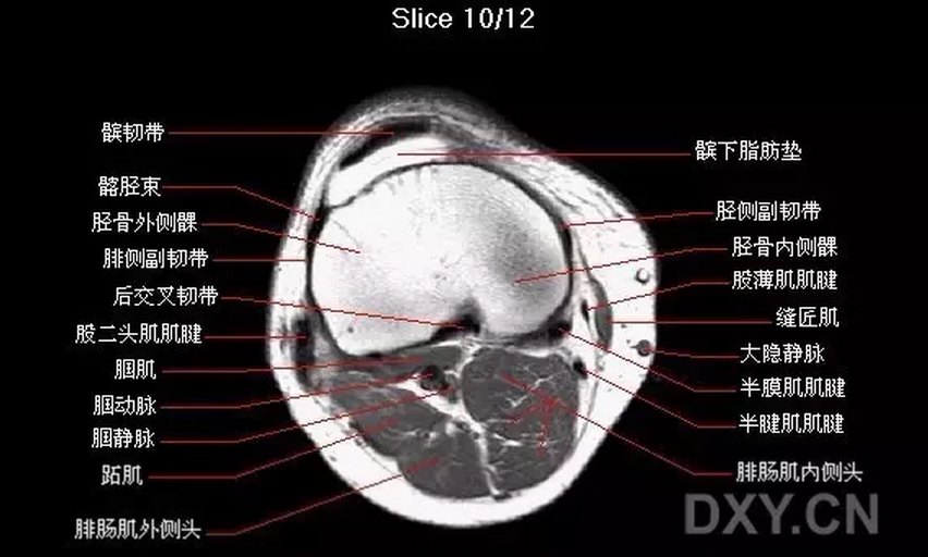 下肢肌肉MR断层解剖图片
