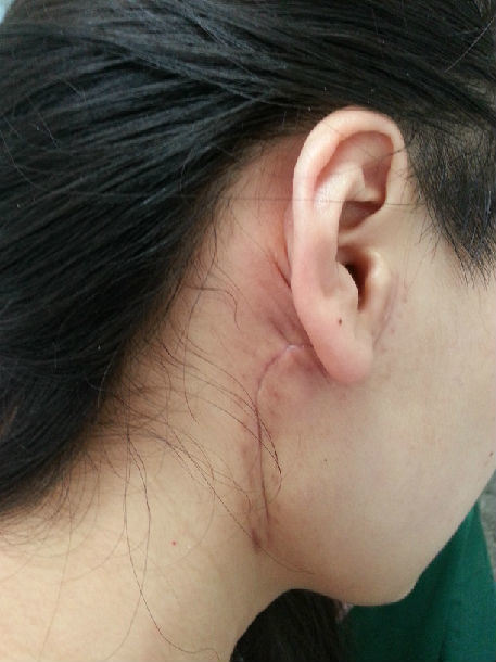 腮腺手术后进食出汗综合征和面部塌陷的预防