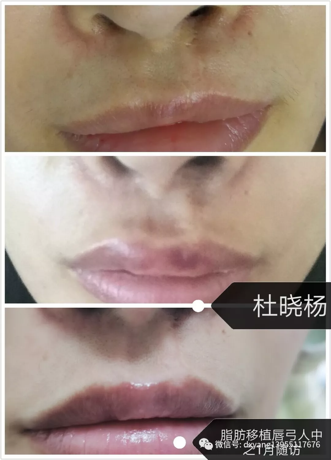 如何预防脂肪栓塞