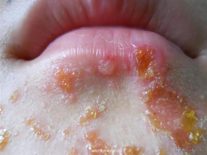 这是一篇关于脓疱疮的科普