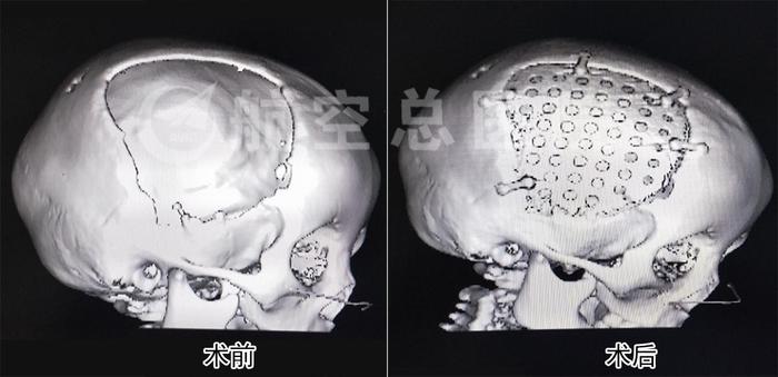 peek顱骨修復整形術為三歲女孩重塑完美童顏