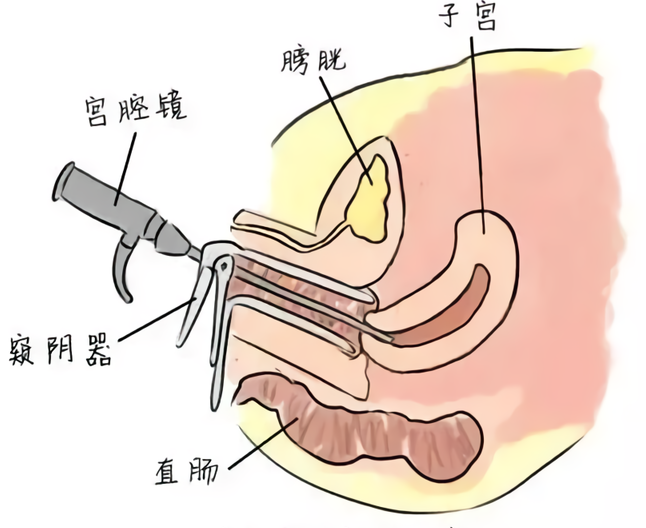 疾病科普宫腔粘连的治疗