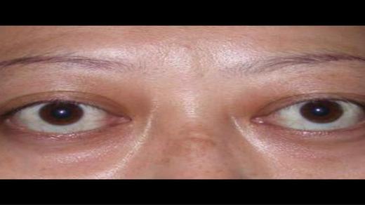 "甲亢突眼"你了解多少?——常见表现及实验室检查是什么?