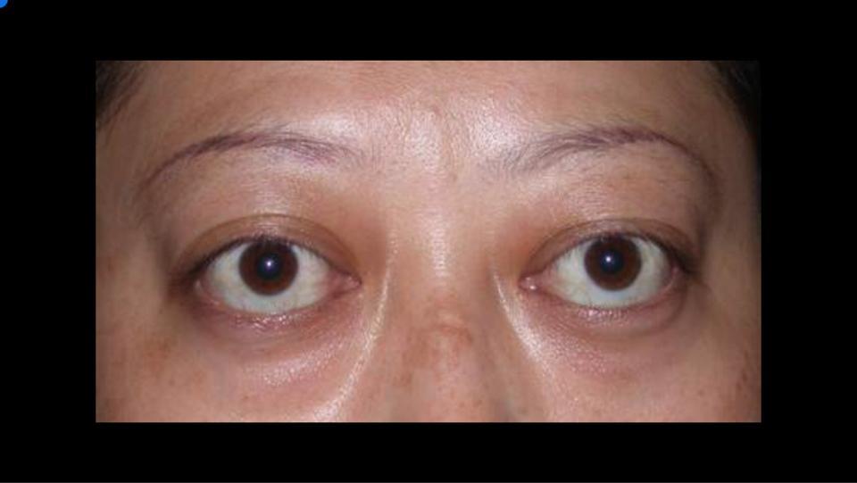 甲亢突眼有关手术费用和时间等六大问题
