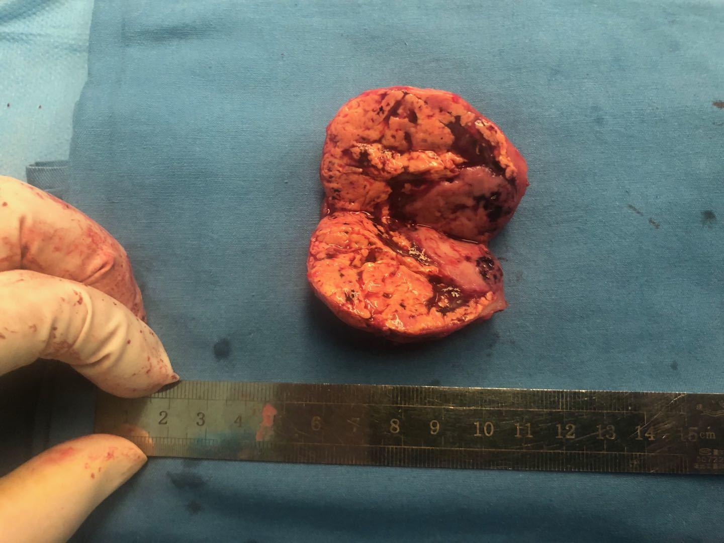 右肾中央型肿瘤5厘米行腹腔镜肾部分切除一例