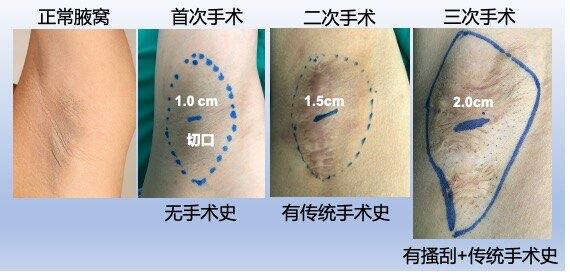 小切口腋臭手术图解图片