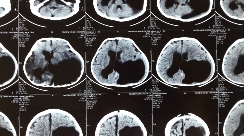 切莫忽视儿童脑发育不良的早期诊治脑室穿通畸形的手术
