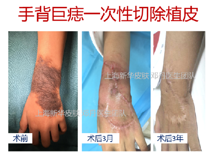 病例系列03手背巨大兽皮痣全切植皮