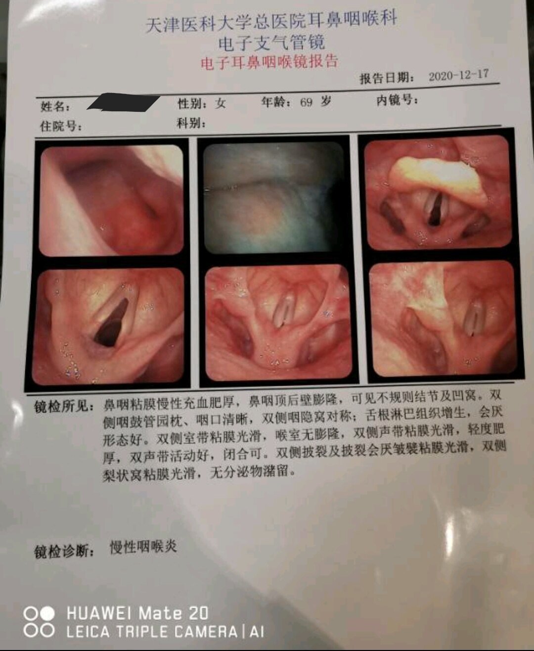 正常喉镜报告图片图片