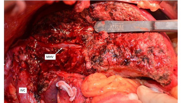 不可切除晚期肝癌经靶向 免疫等综合治疗后成功根治性切除