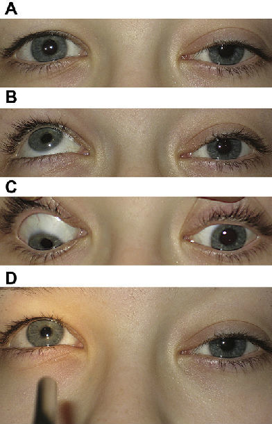 体征包括:(1)上睑下垂可完全或不全;(2)眼肌麻痹,原位外斜,伴眼球内收