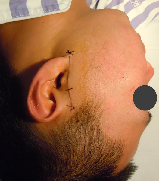 颞下颌关节手术的耳前切口的瘢痕有图片