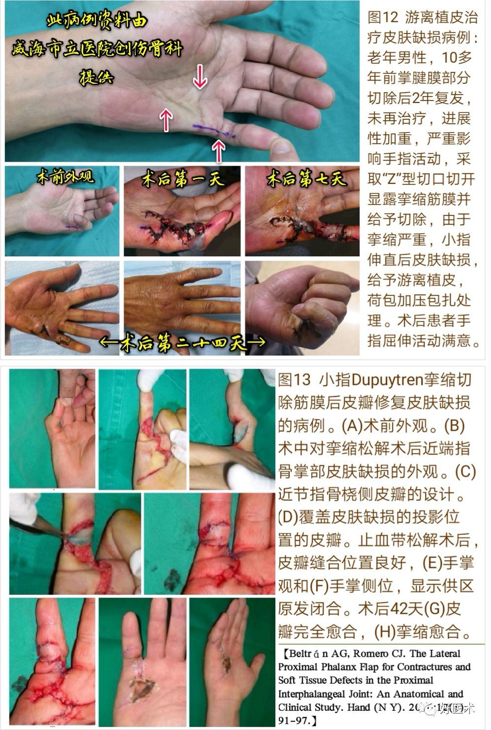 掌腱膜挛缩症的诊治技巧系统详解