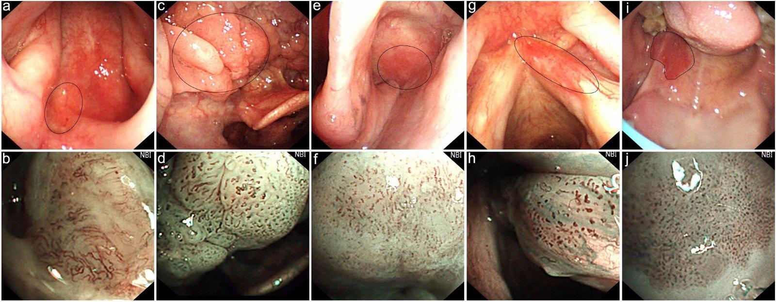 窄带成像内镜在鼻咽癌早期诊断中的作用.