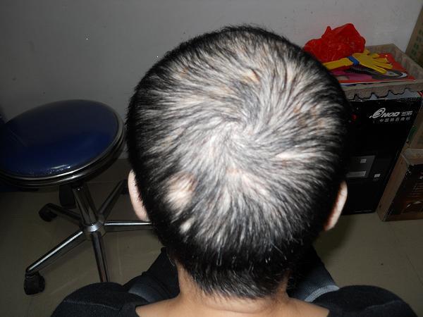 2009年治疗的一例全秃女病例