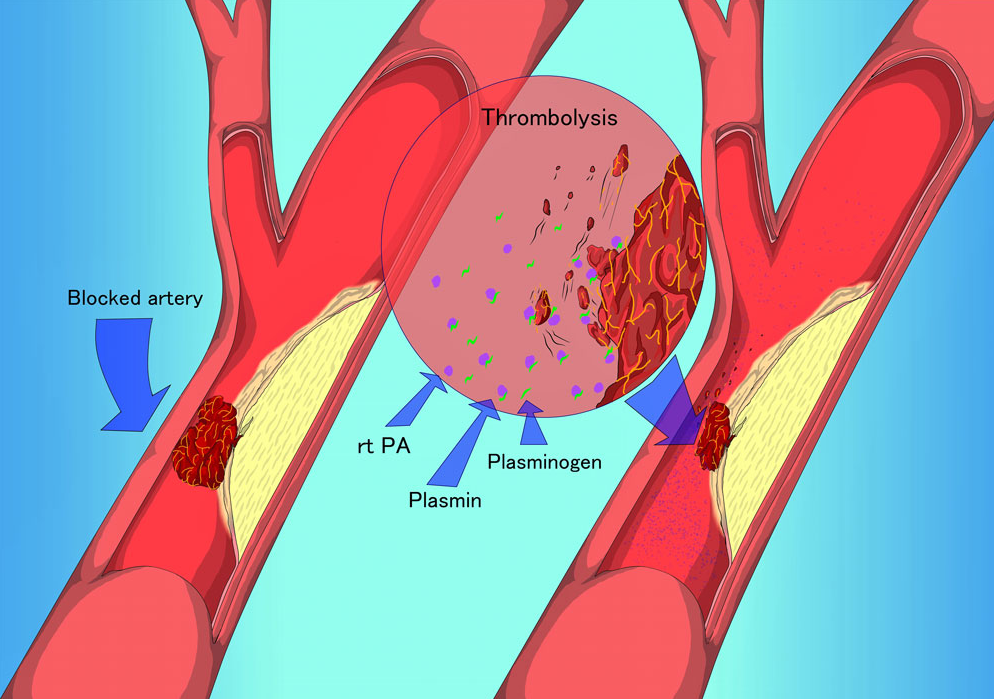 肺栓塞导管溶栓是最适合的治疗