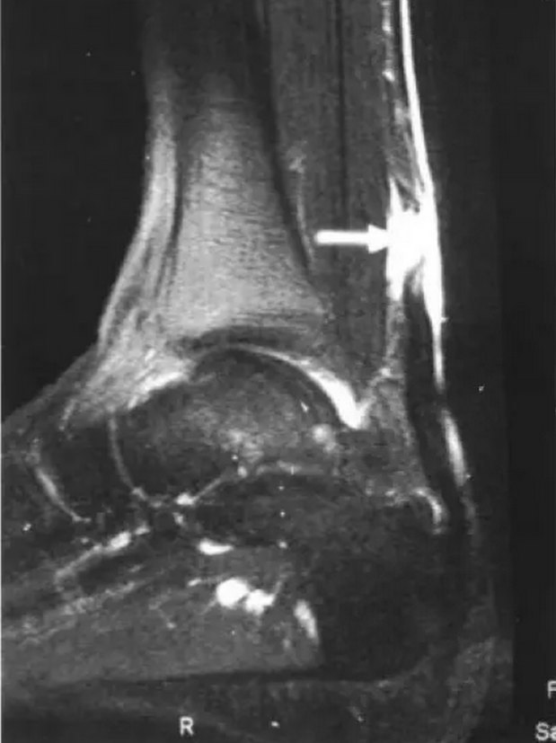 跟腱断裂mri图片