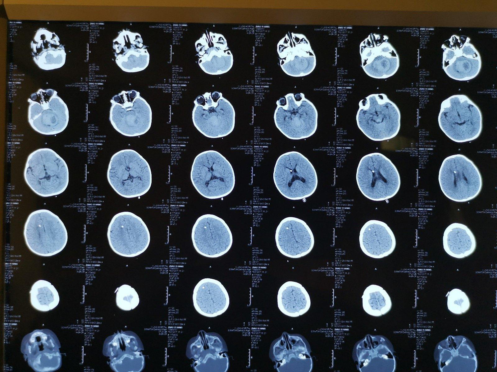 贺晓生教授谈儿童脑瘤:儿童四脑室室管膜瘤手术 - 微医(挂号网)