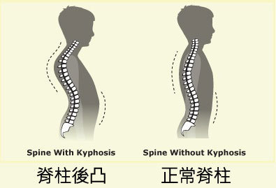 驼背是一种常见的脊柱畸形,6-12岁的孩子最容易出现姿势性驼背,其实质