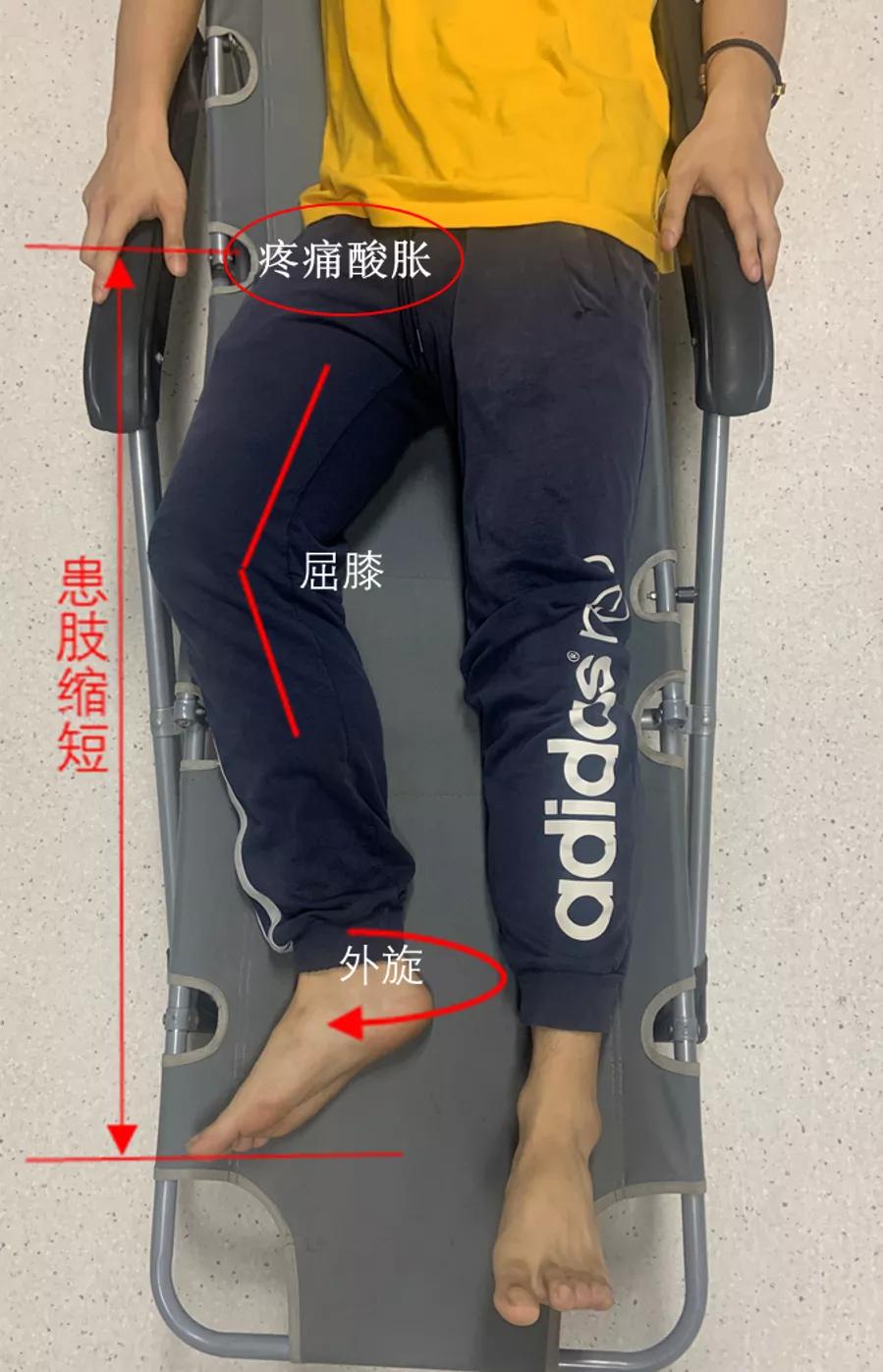 老年髋部骨折人生最后一次骨折一股骨颈骨折