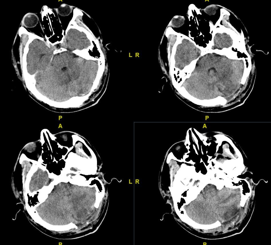 手术治疗多发小脑转移瘤一例