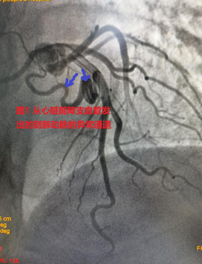 冠状动脉肺动脉瘘不开胸能治愈吗