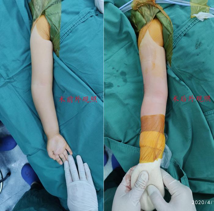 典型病例儿童肘内翻畸形的治疗