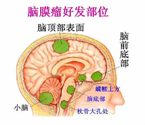 脑膜瘤位置图解图片