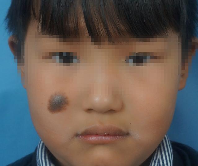 代涛博士黑毛痣用激光治疗不管用应该怎么办