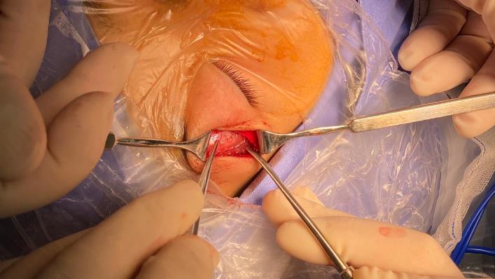 外科笔记眼眶肿瘤皮样囊肿之一切除联合一期骨壁重建