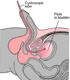 女性膀胱 膀胱镜图片