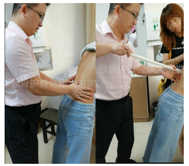 早期发现的脊柱侧弯在棍点手法间断支具治疗后半年1年随访,已从14度