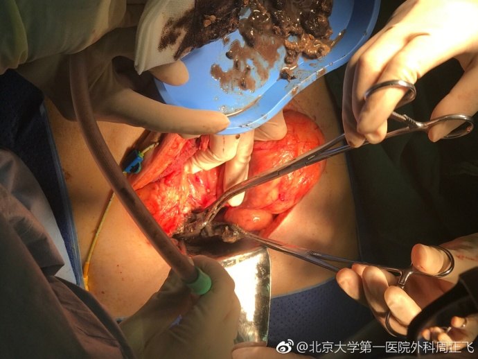 急性重症胰腺炎感染坏死性胰腺炎胰腺脓肿的手术救治