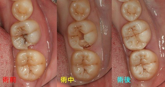 病例三窝沟龋坏明显去掉腐蚀以后,窝洞冲洗,消毒,十