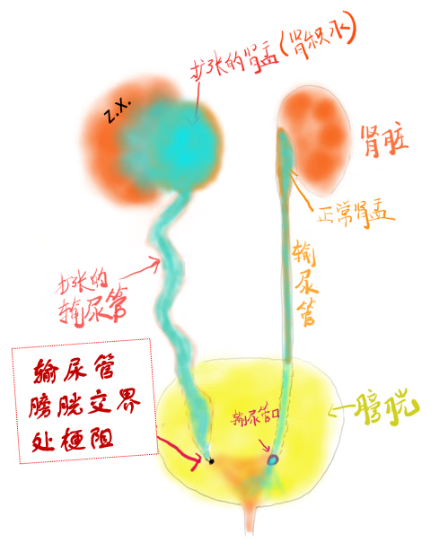 宝宝查出肾积水怎么办
