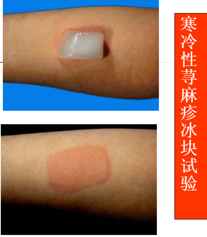 更有甚者水源性荨麻疹.