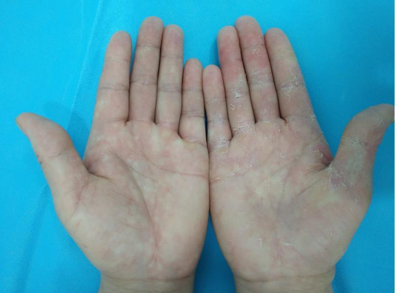 手足癣认识 - 微医(挂号网)