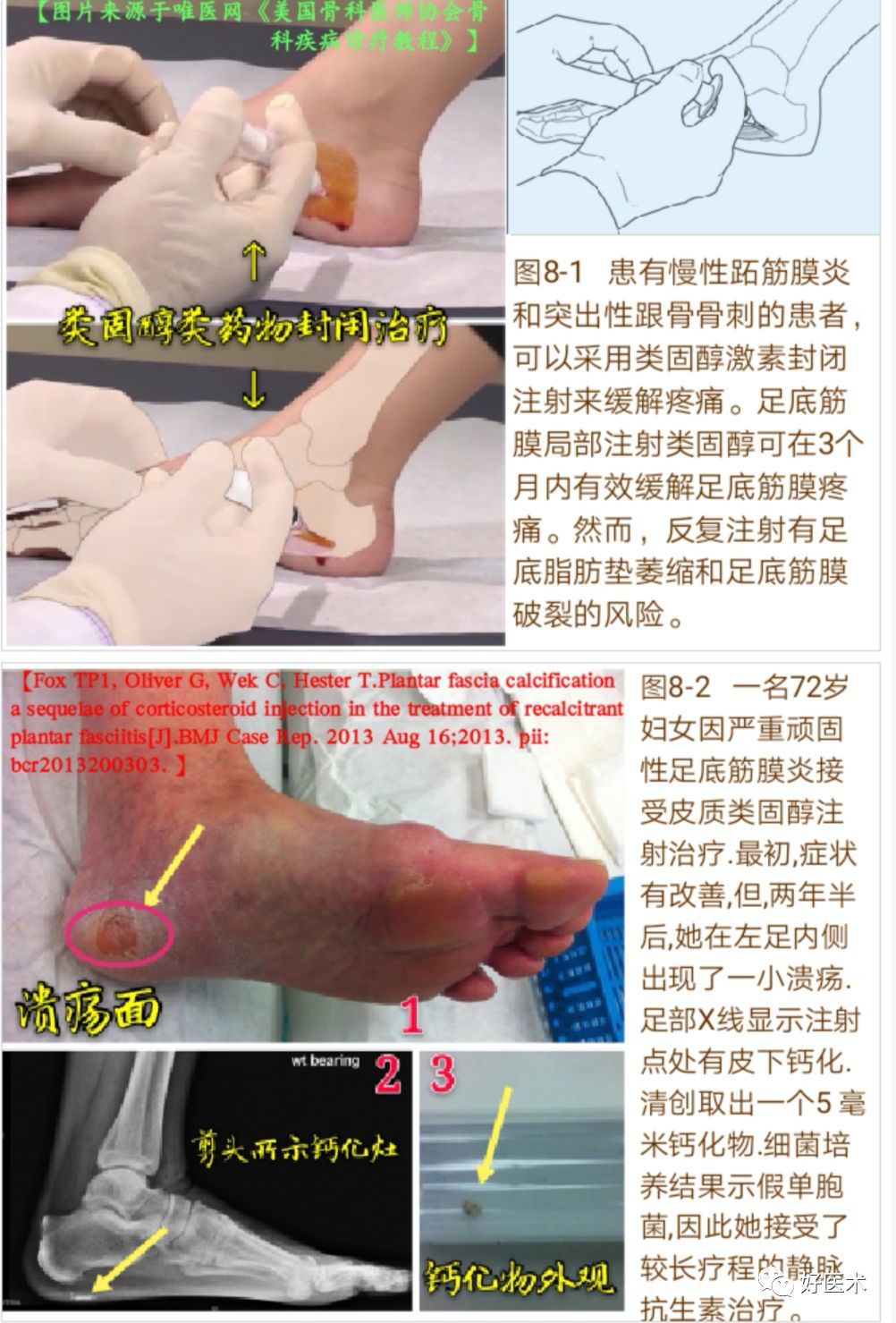 局部注射富血小板血浆(prp)是治疗足底筋膜炎的一种新方法(图9).