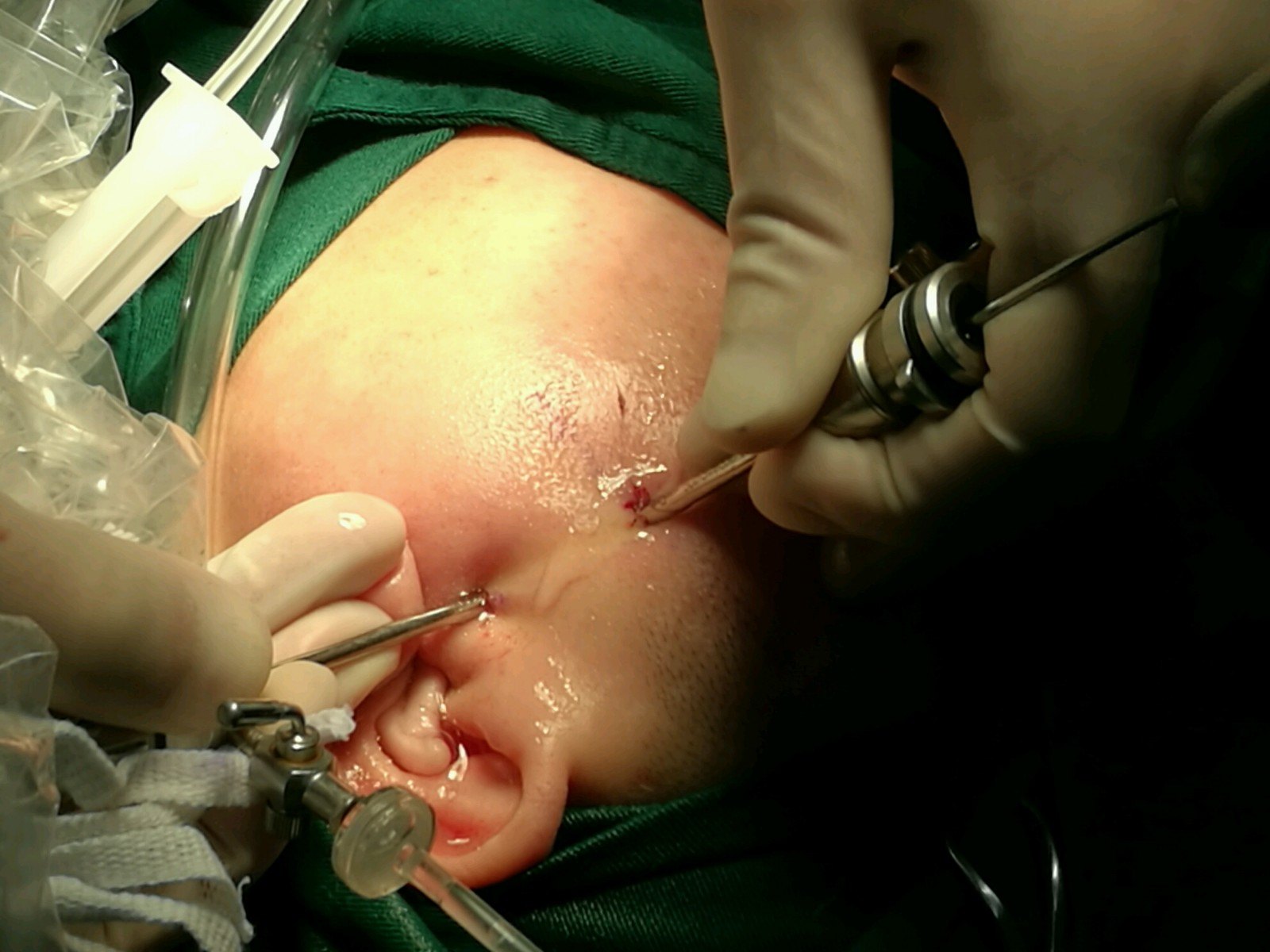 诊疗颞下颌关节紊乱病颞下颌关节镜微创治疗