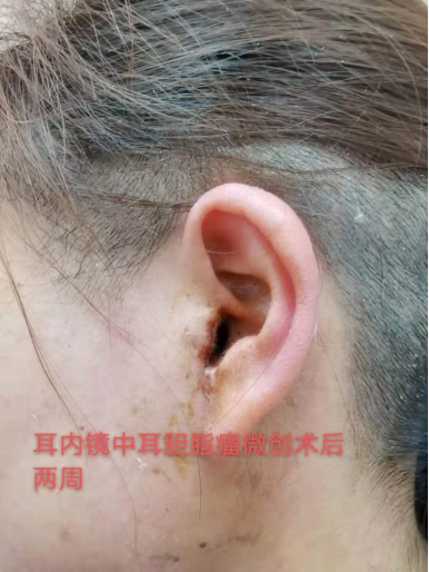 中耳炎手术切口刀疤图图片