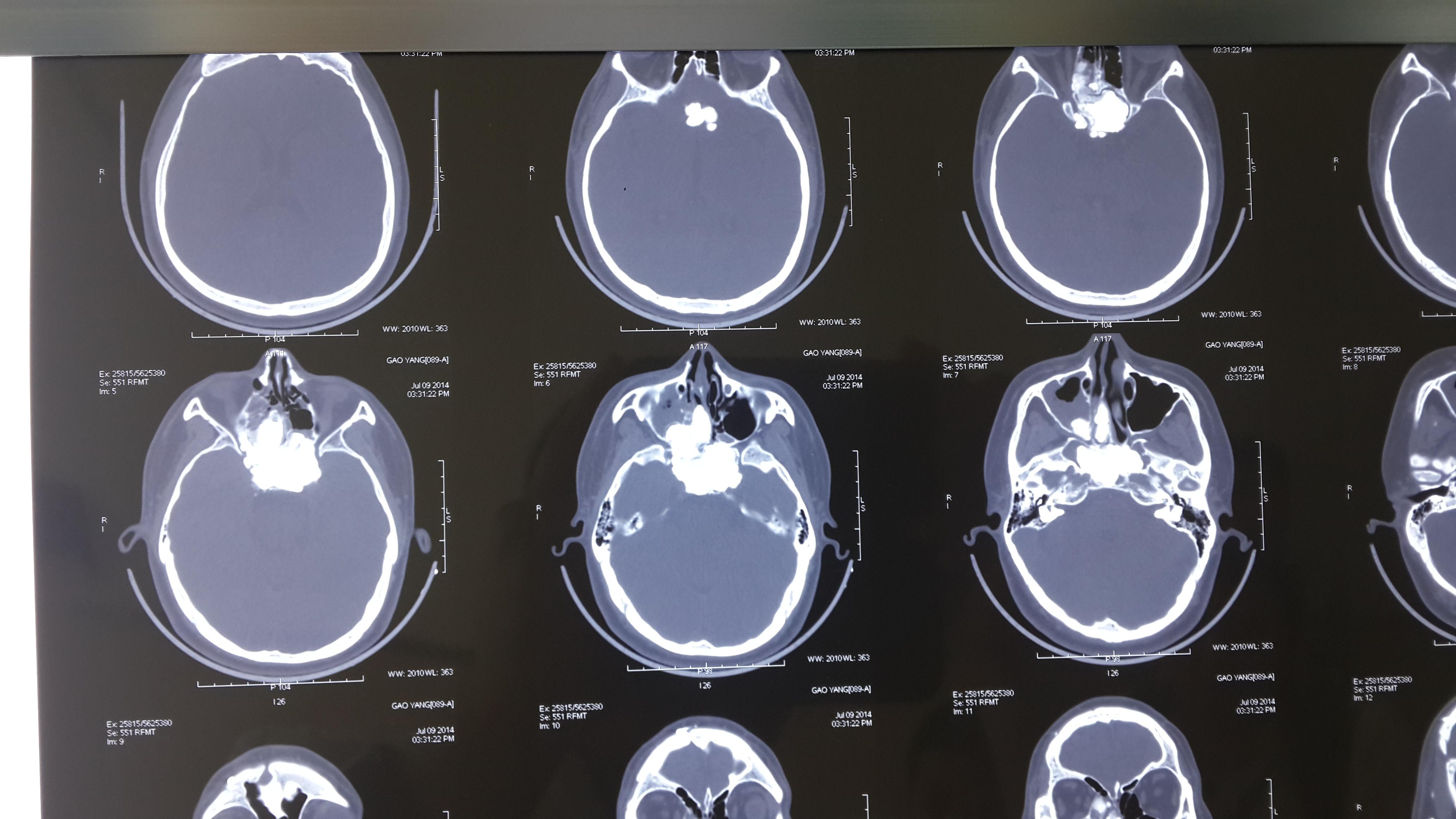 ct:前颅底中线区域大片状钙化,延至后组筛窦,眶,前床突,鞍背等区域.
