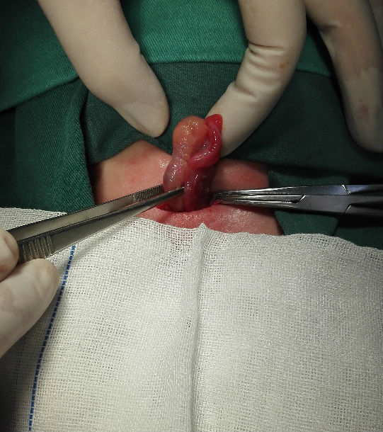 女宝宝也会患疝气或鞘膜积液吗