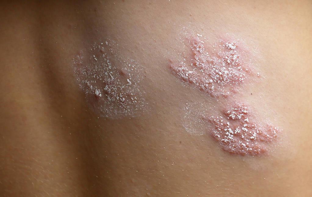 淋巴细胞是逐渐进行的,淋巴细胞不下降到一定程度,不一定会表现出症状