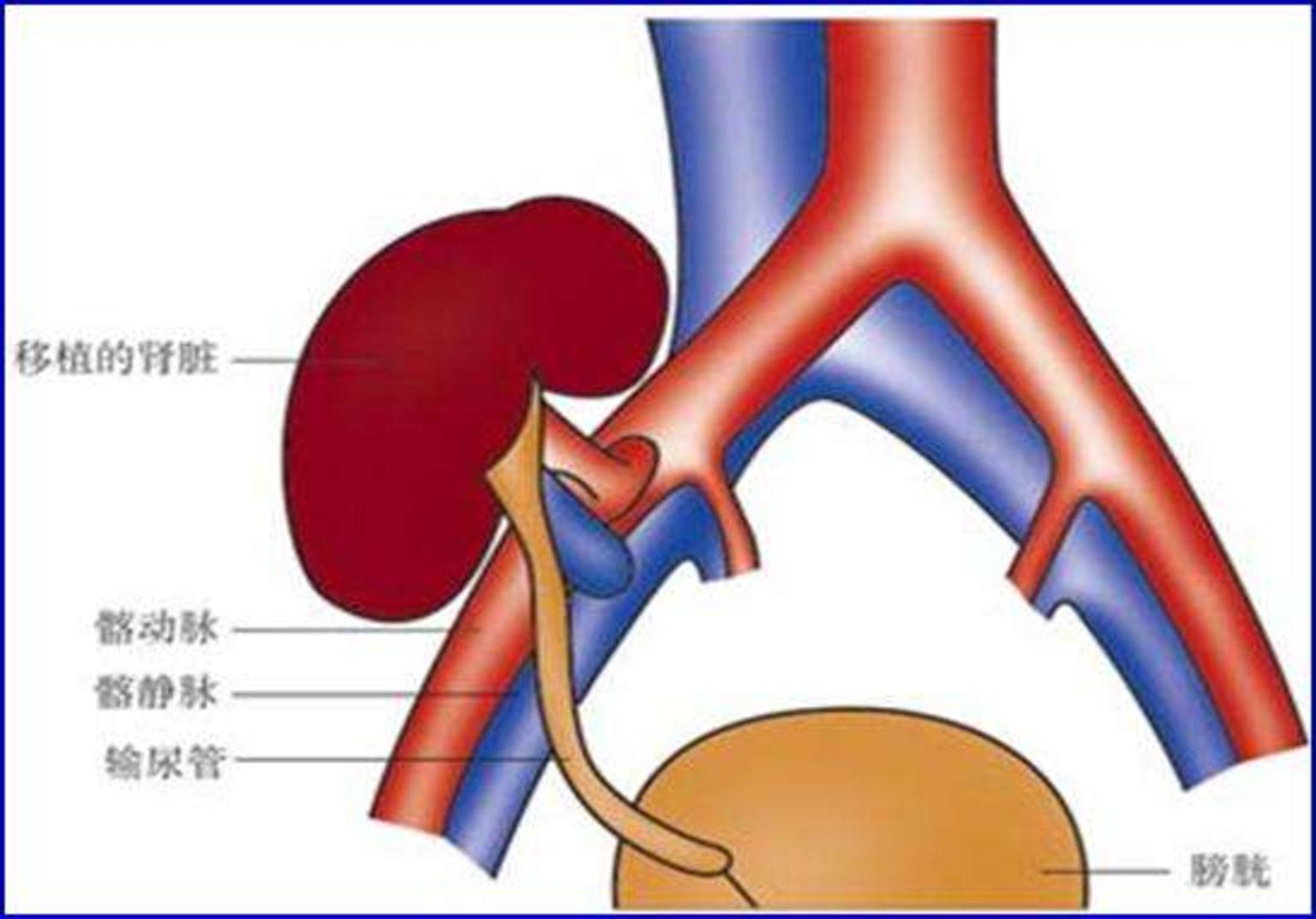 肾移植怎么做图解肾移植