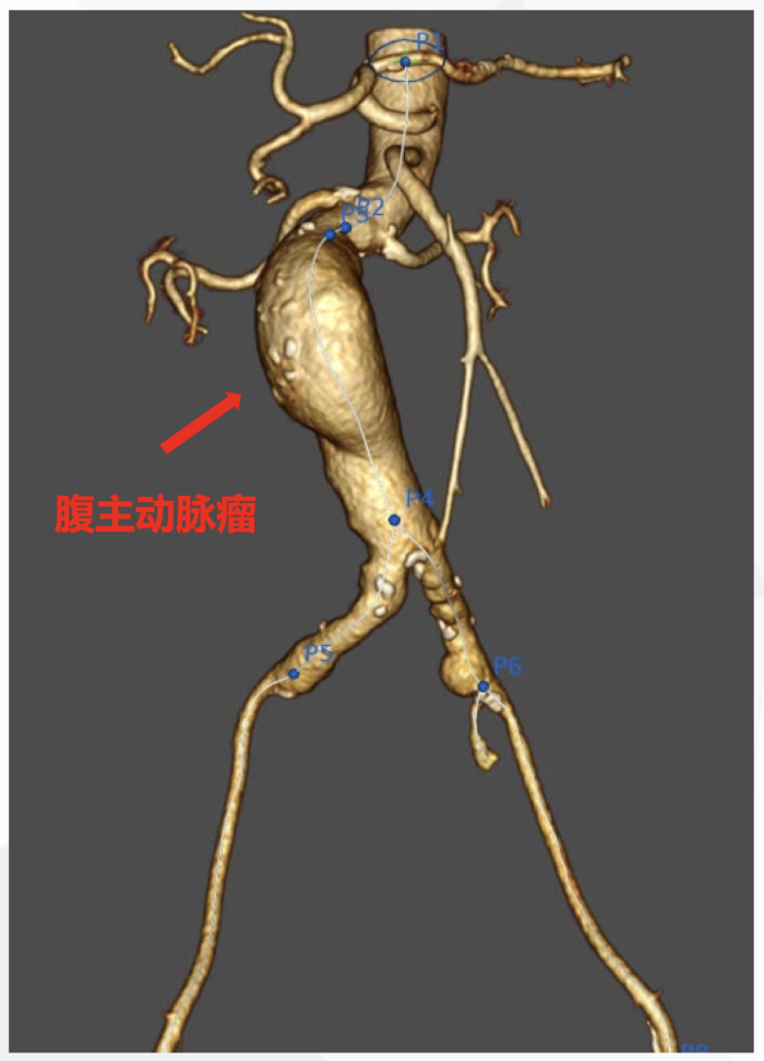 微创治疗复杂腹主动脉瘤一例